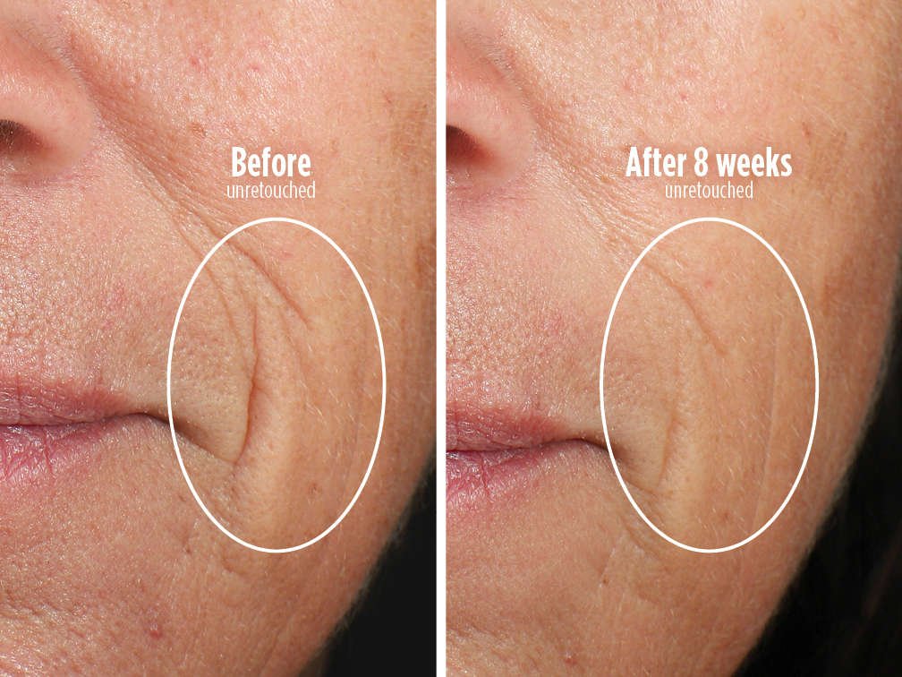 Shark CryoGlow — glowing results