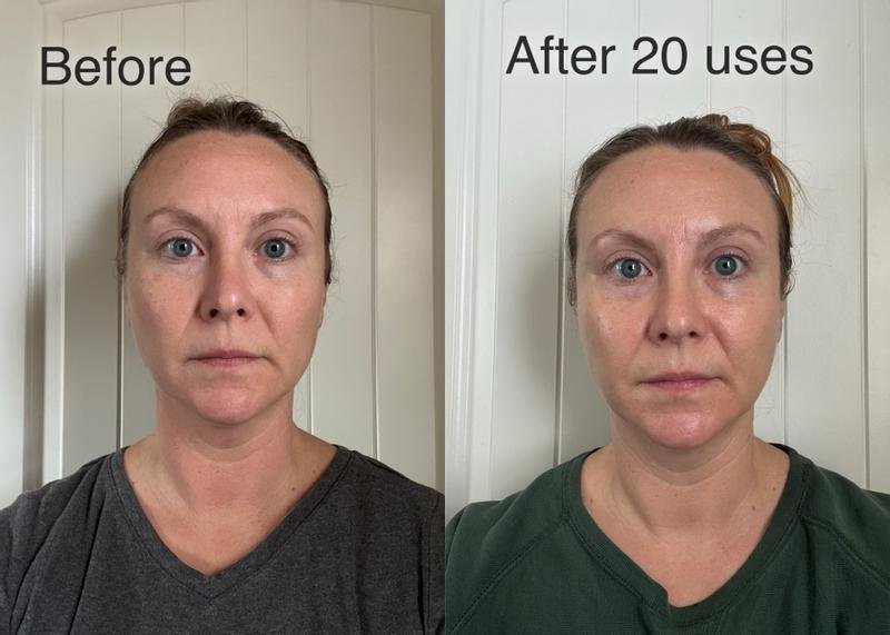Results after using Shark CryoGlow